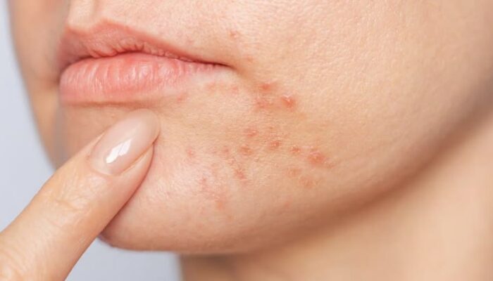 Mitos Face Mapping Jerawat dan Organ Dalam, dr Ruri Diah Pamela: Belum Ada Bukti Ilmiah Kuat